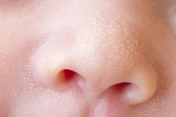 Milium cysts (milia) in newborns