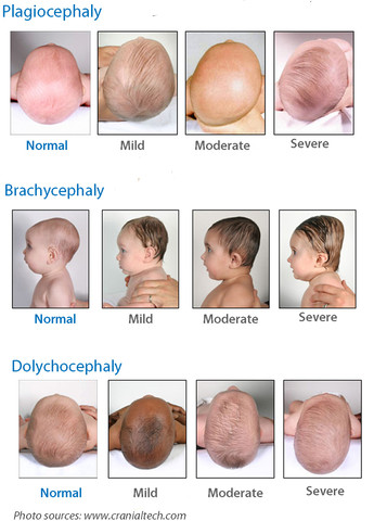 Severity of flat-head syndrome